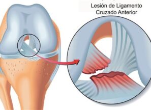 lESIONES LIGAMENTARIAS