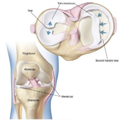 lESIONES MENISCALES