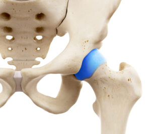 pinzamiento femoroacetabular