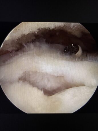 Sección rodilla 2 (artroscopia)