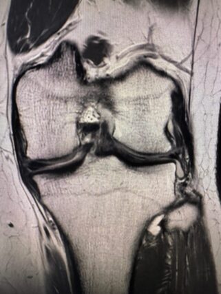 Sección rodilla 3 (RMN)